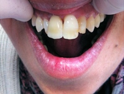 Staining on the natural teeth  has been closely imitated in the crown