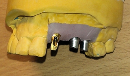 Abutments in place in soft tissue
