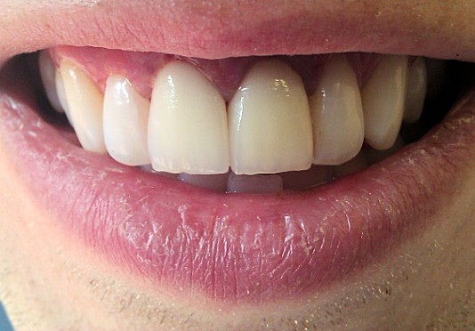 The fitted Zirconia Crowns
